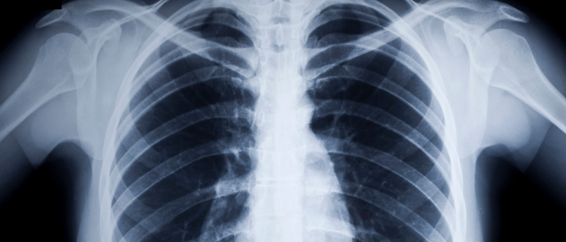 Algorithm Diagnoses Lung Diseases - BioTechniques